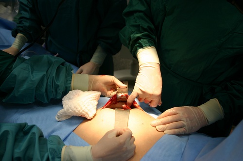 В зоне АТО прошла первая операция в полевых условиях. Хирург спас жизнь разведчика