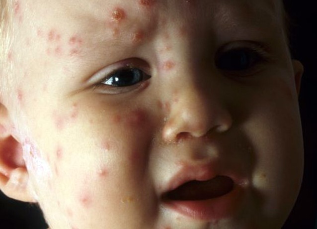 В Україні поширюється жахливий вірус, який вражає дітей