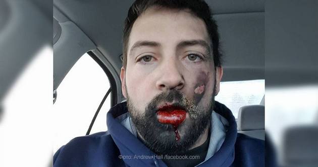 У мужчины во рту взорвалась электронная сигарета: ожог лица и минус 7 зубов. ФОТО