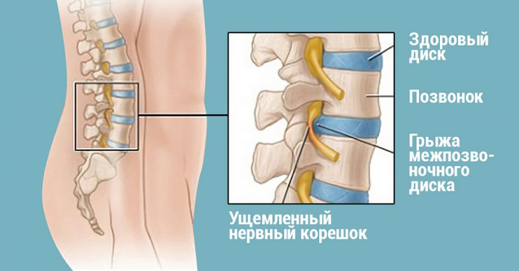 Хирург отговорил меня от операции, посоветовав делать эти упражнения. Через полгода все пришло в норму!