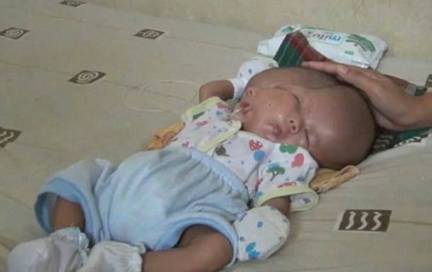 В Индонезии ребенок-мутант шокировал врачей