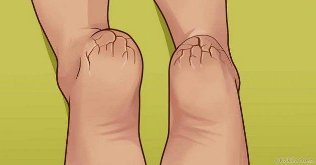 Если вы страдаете от сухой кожи на ступнях, обязательно прочтите эту статью