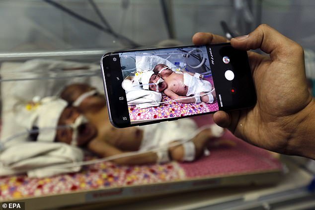 Одно тело на двоих: в Йемене родились редкие сиамские близнецы.ФОТО