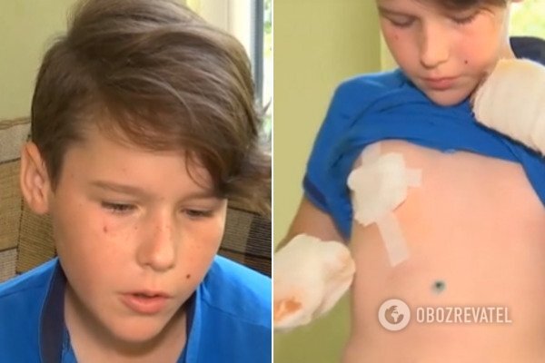 ЧП под Одессой: в руках 11-летнего мальчика взорвалась петарда. ВИДЕО