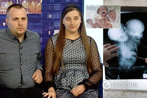 Родители сиамских близнецов из Черновцов пришли на ТВ и рассказали всю правду. ВИДЕО