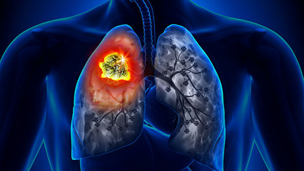 Врачи назвали первые признаки рака легких: срочно к специалисту!