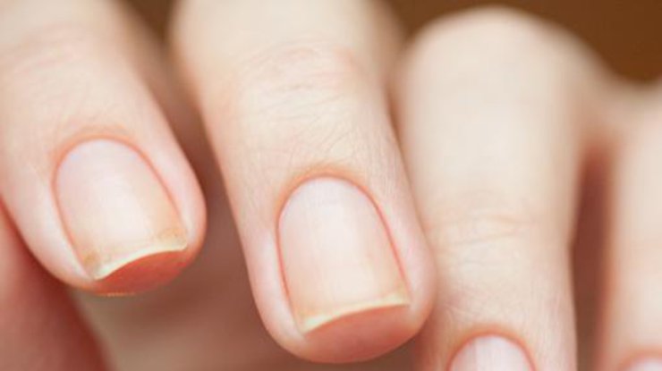 О каких заболеваниях расскажут ямочки на ногтях