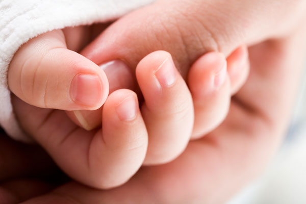 Родители отказались удалять огромное родимое пятно на лице новорожденной дочки. ФОТО