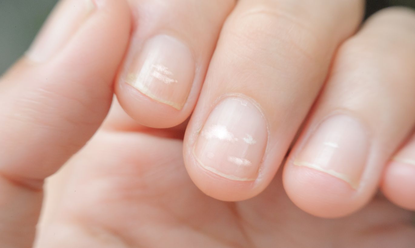 О какой опасности могут предупредить белые полоски на ногтях