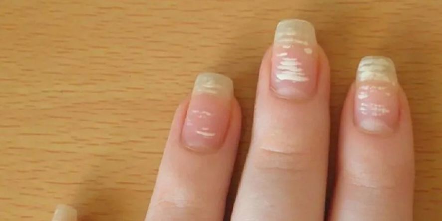 Бороздки и пятна: о каких опасных болезнях предупреждают ногти