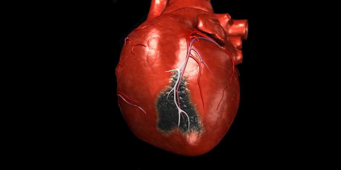 Признаки инфаркта, при которых нужно звонить в скорую