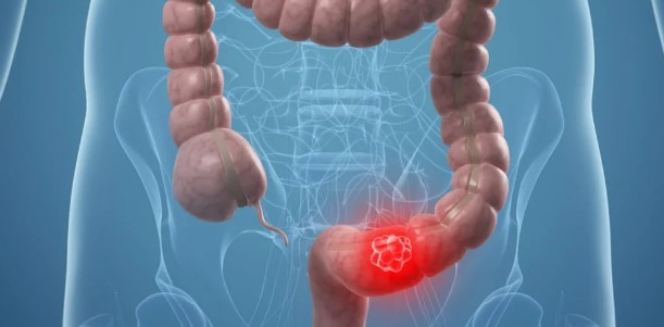 Онкологи назвали необычный признак рака кишечника